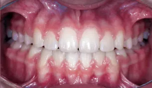 Caso Aline — depois do implante unitário