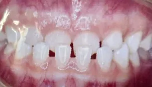 Caso Aline — antes do implante unitário