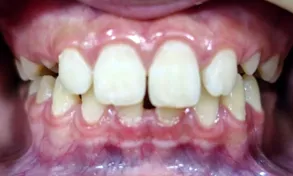 Caso Aline — depois do implante unitário