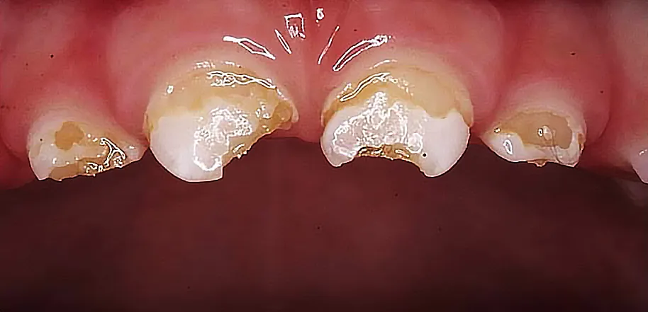 Caso Enzo — antes do tratamento de cárie em dente de leite