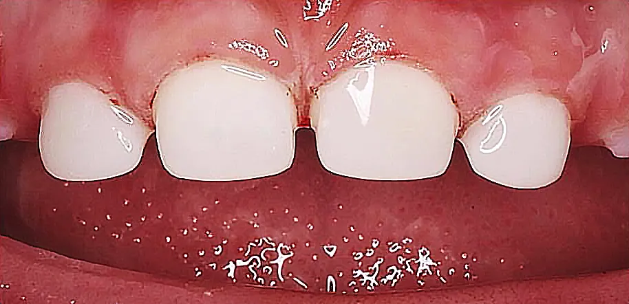 Caso Enzo — depois do tratamento de cárie em dente de leite