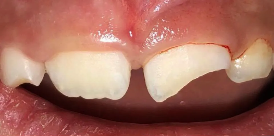 Caso Aline — antes do tratamento odontopediátrico