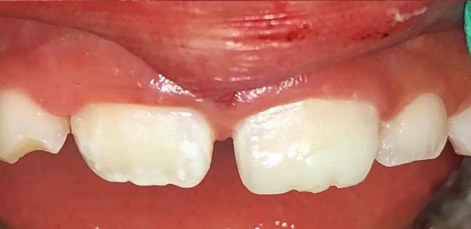 Odontopediatria na Tonon Odontologia, cuidado infantil na Penha