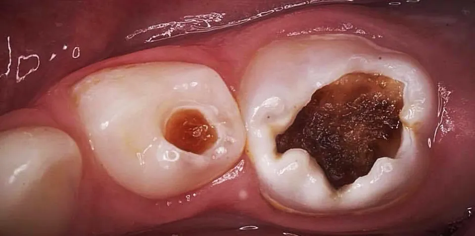 Caso Cláudia — antes do tratamento odontopediátrico