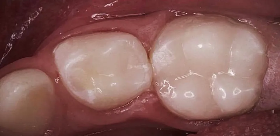 Caso Cláudia — depois do tratamento odontopediátrico