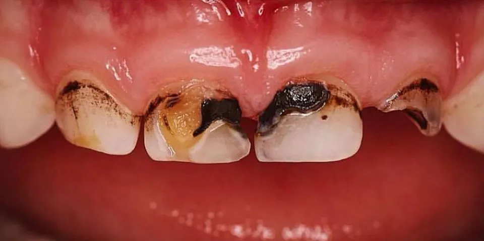 Caso Fernanda — antes do tratamento odontopediátrico