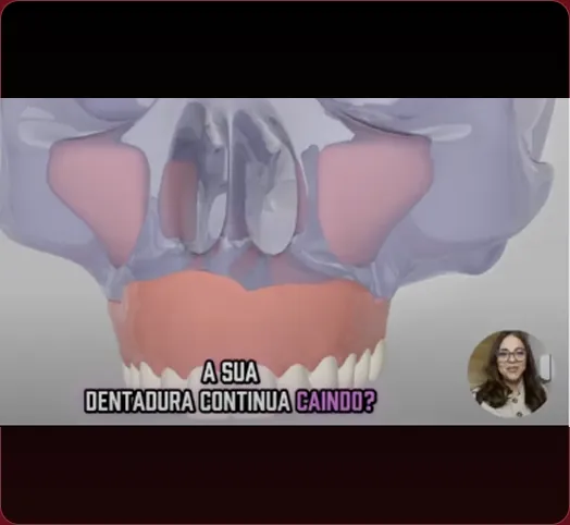 Vídeo explicativo sobre as opções de aparelho